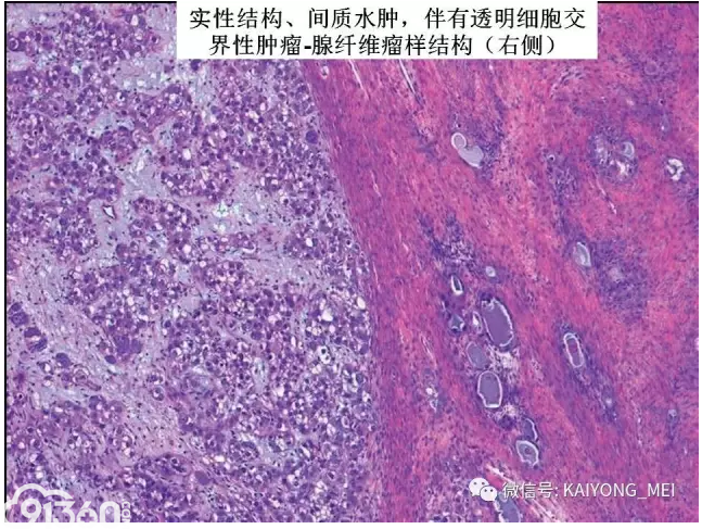 卵巢癌的病理诊断新进展三