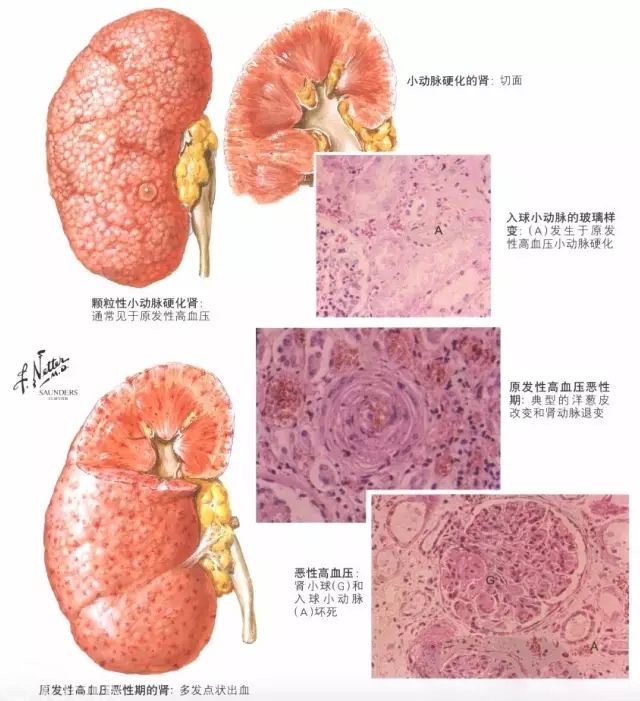 病理学「原发性颗粒性固缩肾」