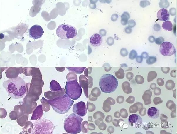 粒系病态(造血)细胞形态学