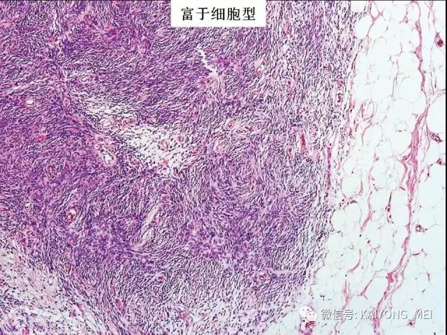 乳腺梭形细胞病变的病理诊断及进展一