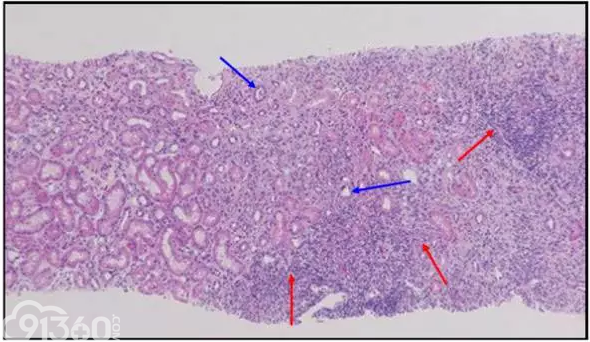 肾内病理图解:小管间质性肾炎