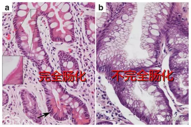 话说"肠化" - 91360智慧病理网