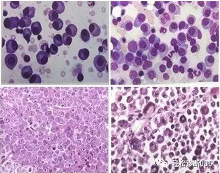 浆细胞相关肿瘤(4)