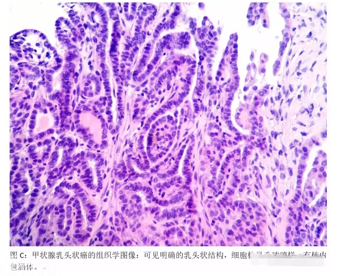 甲状腺乳头状癌的细针和基因诊断 病理杂谈 91360病理论坛