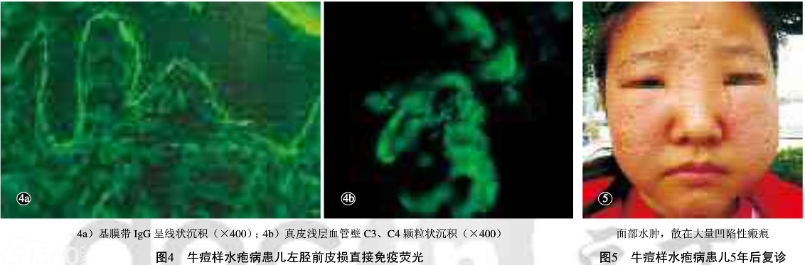 8岁女童患牛痘样水疱病入院治疗病例分析