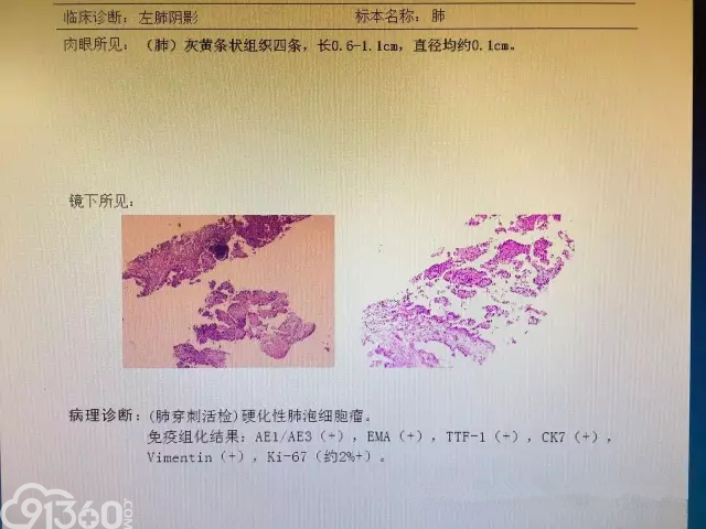 43岁女性患硬化性肺泡细胞瘤入院治疗病例分析