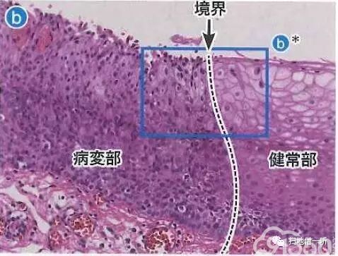 虚线为分界线,右侧为正常鳞状上皮,左侧为肿瘤细胞.