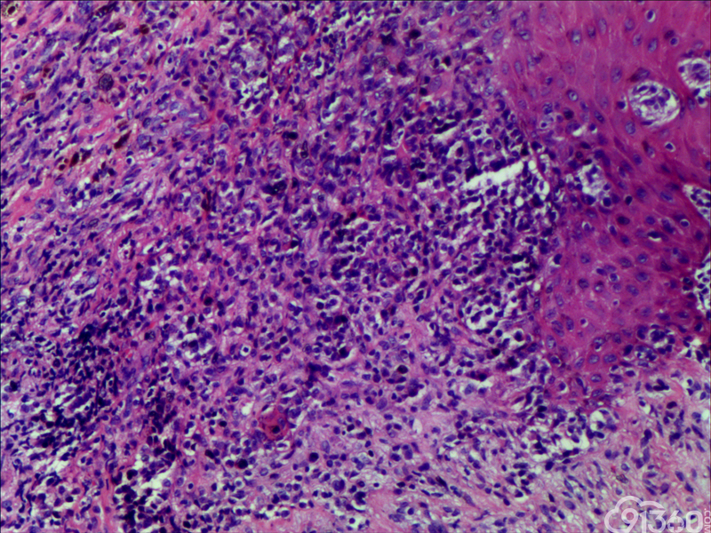 促纤维增生性黑色素瘤 - 病例分析 - 91360病理论坛