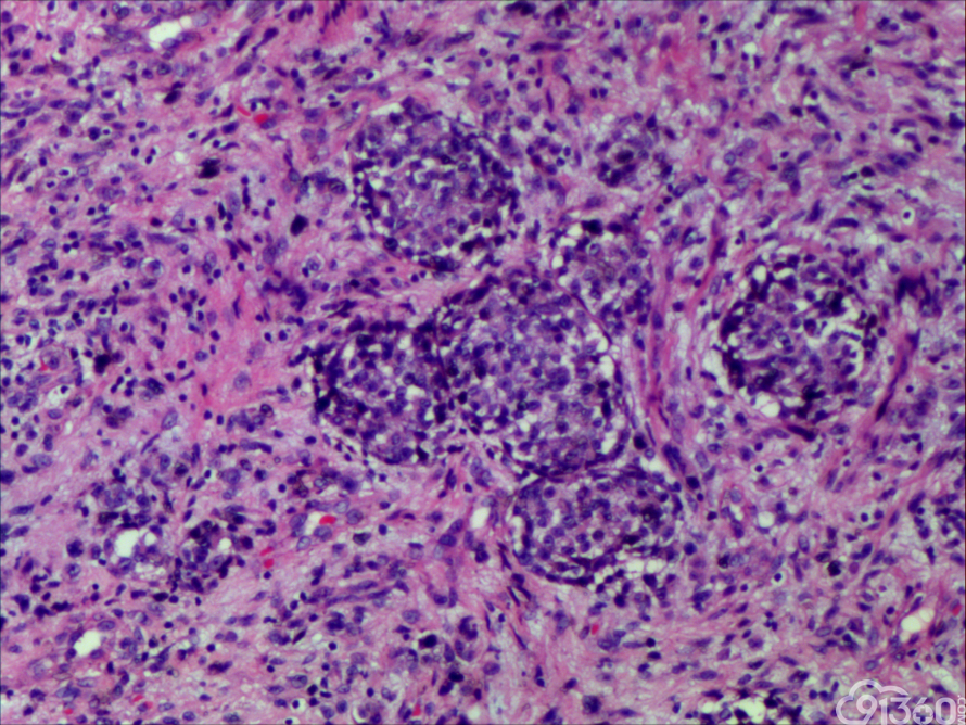 促纤维增生性黑色素瘤 - 病例分析 - 91360病理论坛