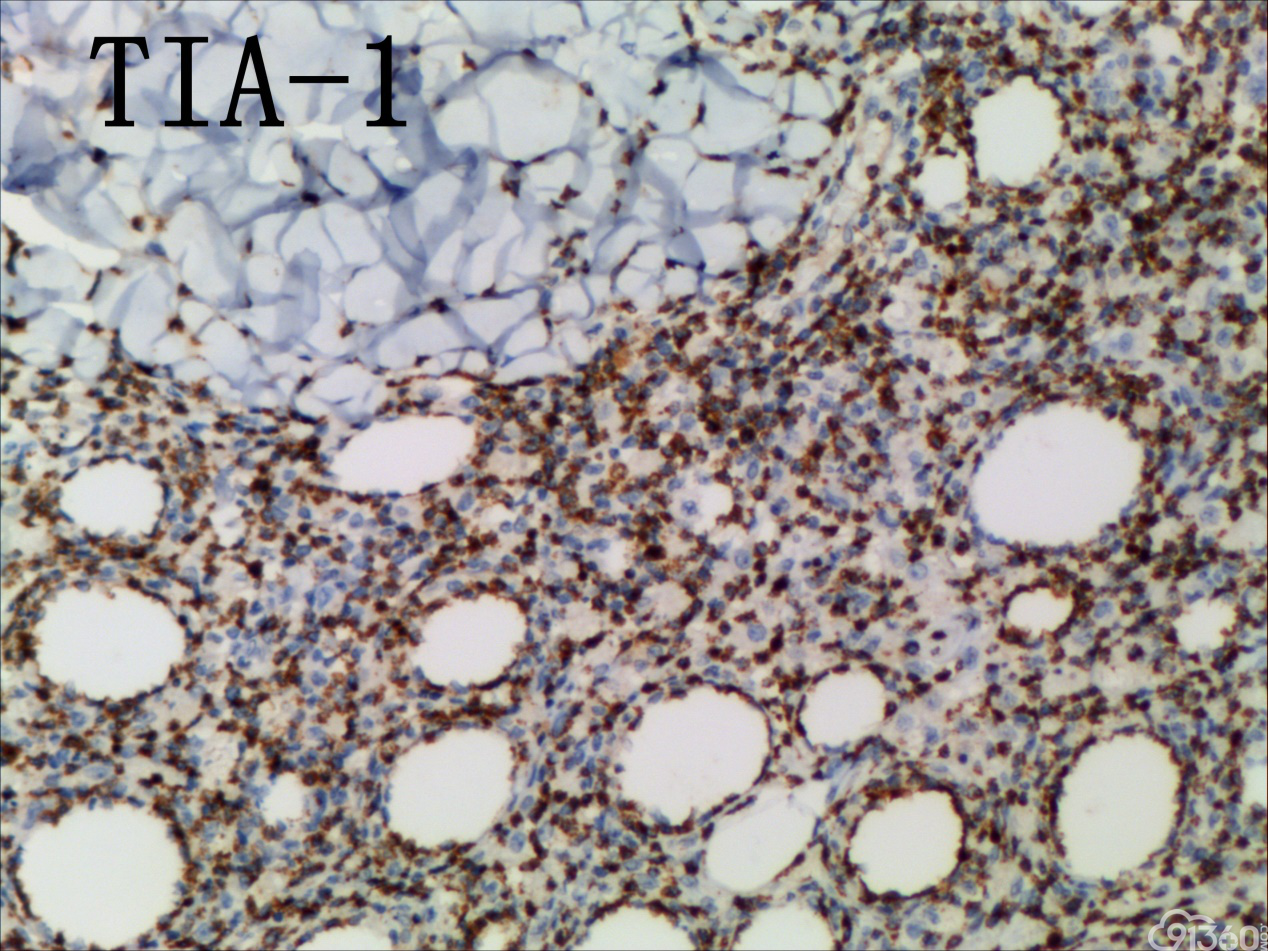 皮下脂膜炎样t细胞淋巴瘤 - 病例分析 - 91360病理论坛