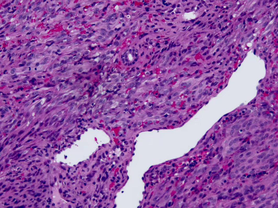 pulmpath #pathology - twitter   dx: kaposi sarcoma. hhv8