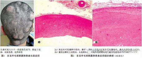 多发性外毛根鞘囊肿一例