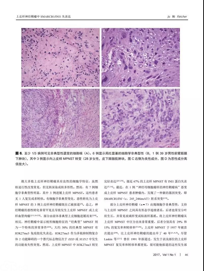 上皮样神经鞘瘤smarcb1/ini1失表达-65例临床病理学及