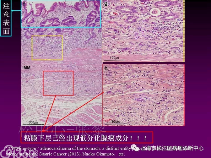 重视类似牵手型胃癌的相关结构异型在活检中诊断胃早癌的意义