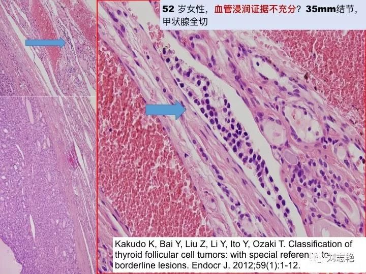 甲状腺病理报告解读(之二)