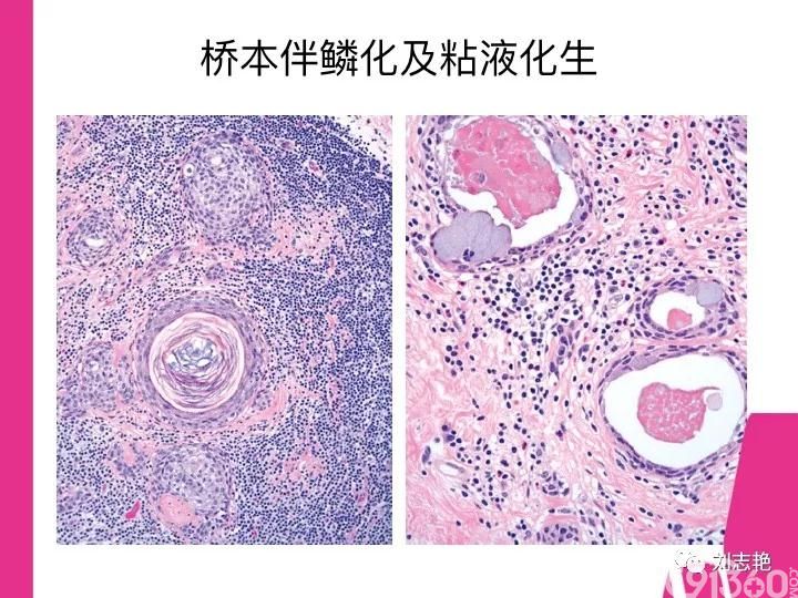 甲状腺病理报告解读(之二)