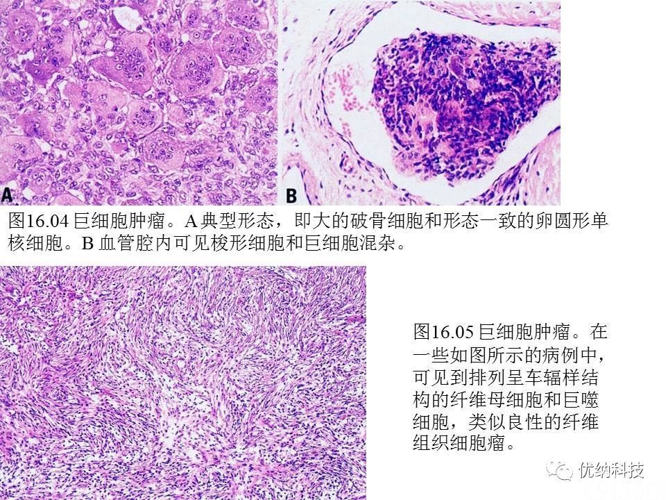 【松林堂】骨组织肿瘤及肿瘤性病变病理诊断中的几个问题(十)