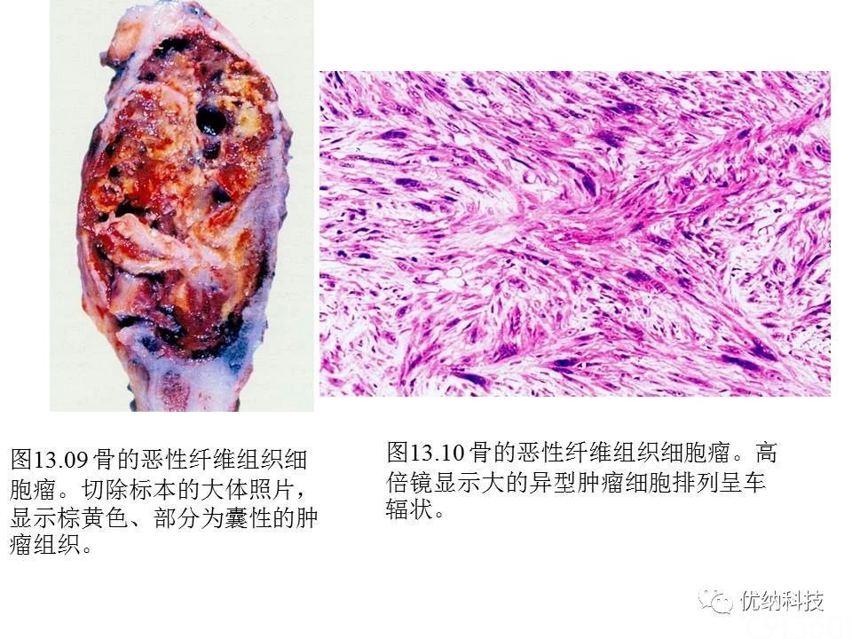 【松林堂】骨组织肿瘤及肿瘤性病变病理诊断中的几个问题(十)
