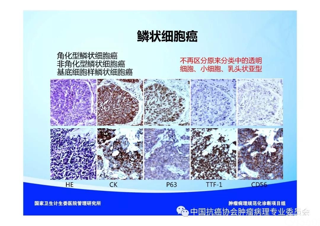 肿瘤病理规范化诊断标准 第3部分:肺癌病理诊断标准