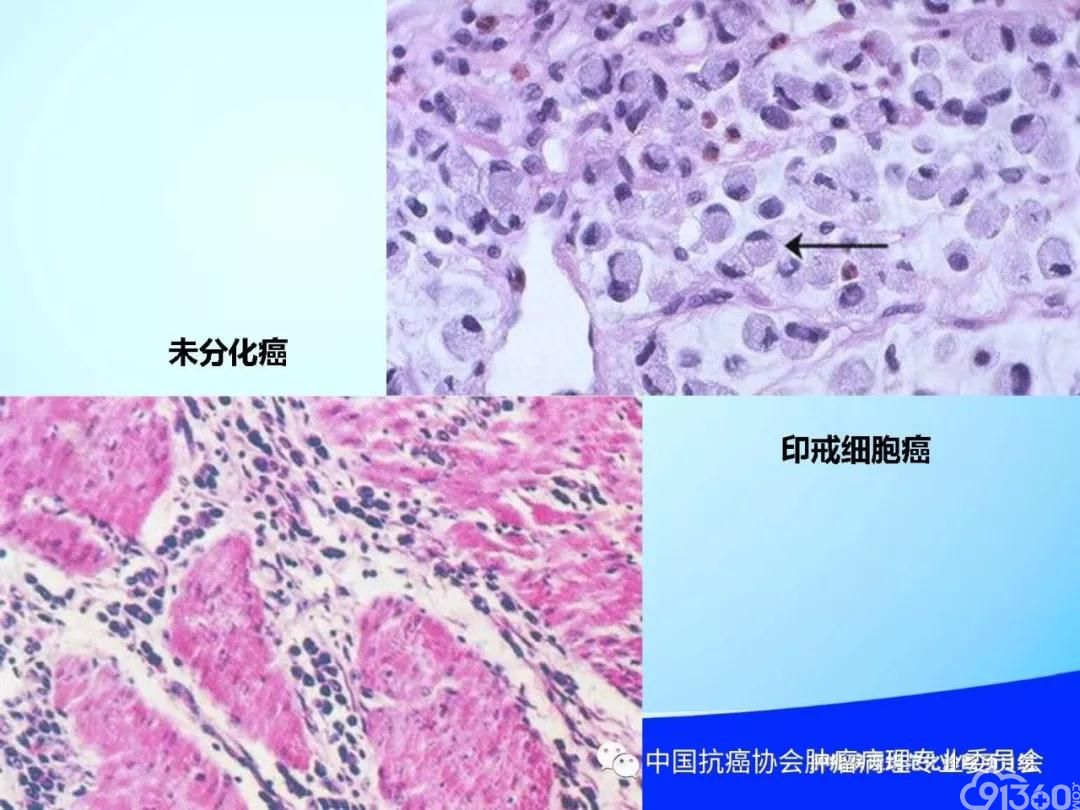 肿瘤病理规范化诊断标准 第4部分:胃癌病理诊断标准