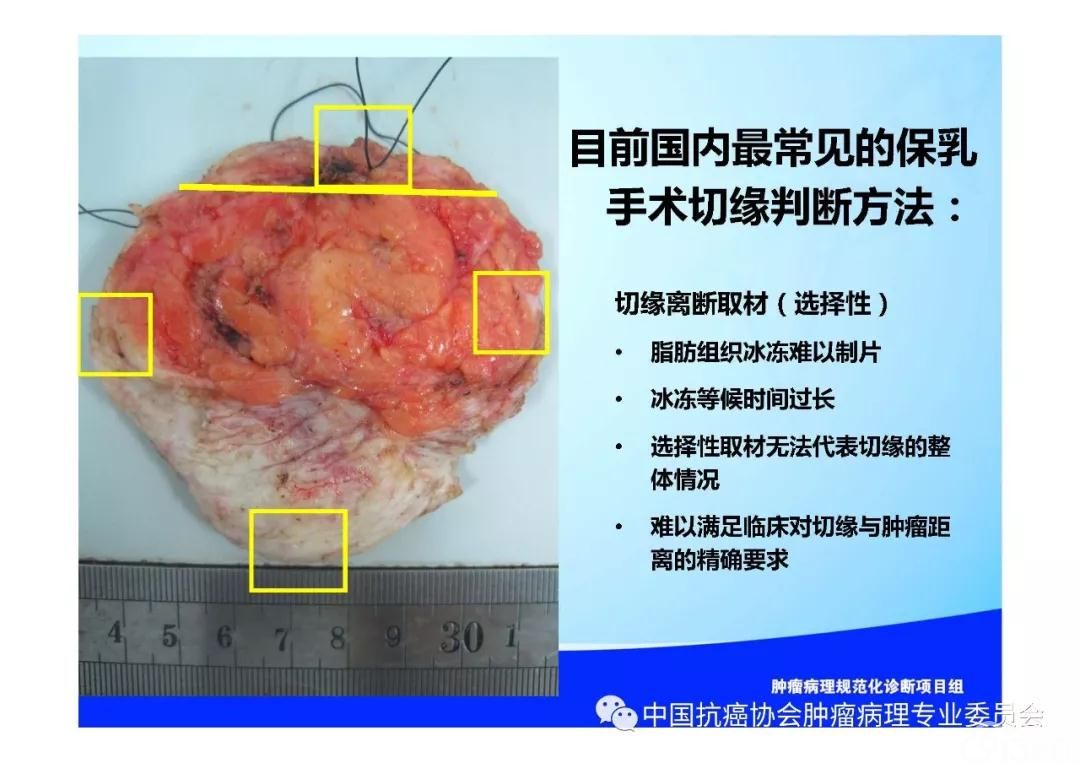 肿瘤病理规范化诊断标准 第5部分:乳腺癌病理诊断标准