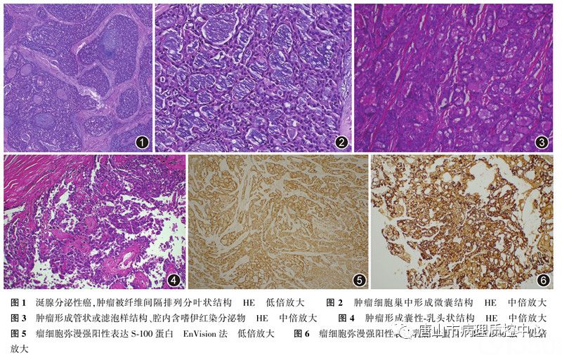 涎腺分泌性癌临床病理特征