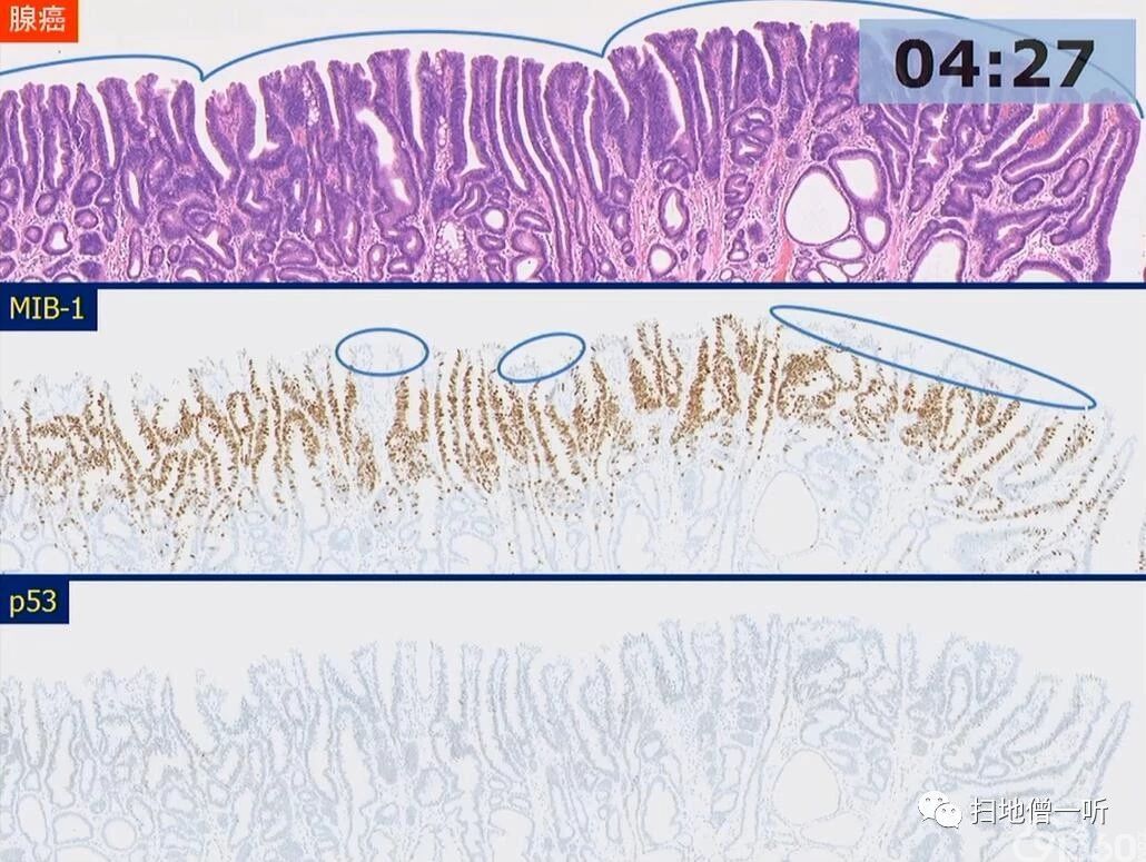 医学美图:腺瘤与超高分化腺癌