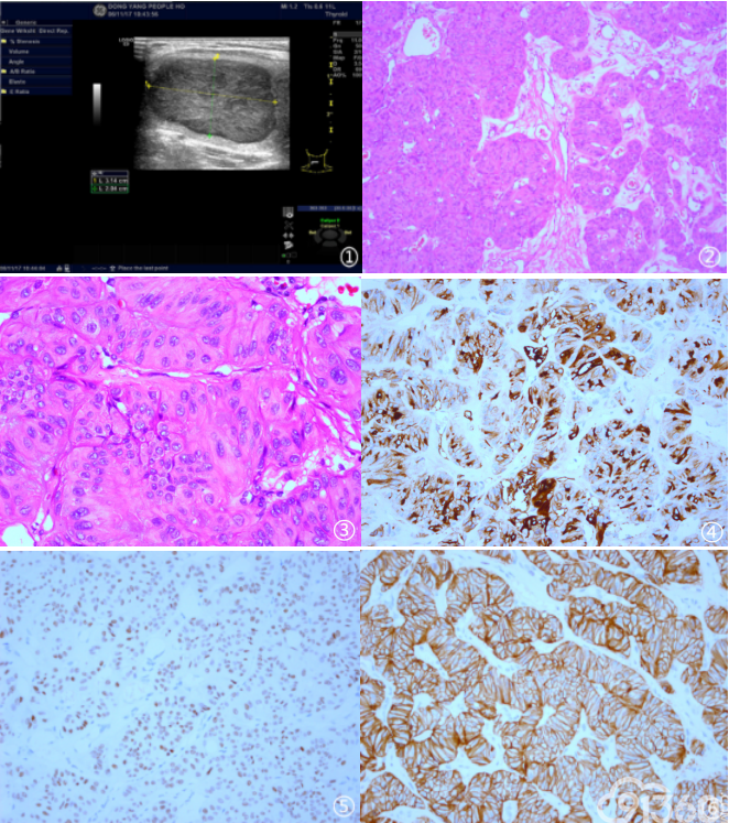 图3显微镜下示肿瘤细胞胞核见明显的核沟和假包涵体,胞质内透明变性