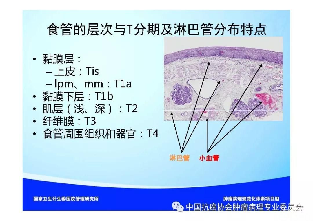 肿瘤病理规范化诊断标准 第7部分:食管癌病理诊断标准