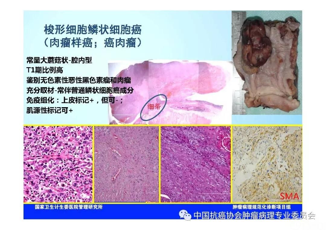 肿瘤病理规范化诊断标准 第7部分:食管癌病理诊断标准