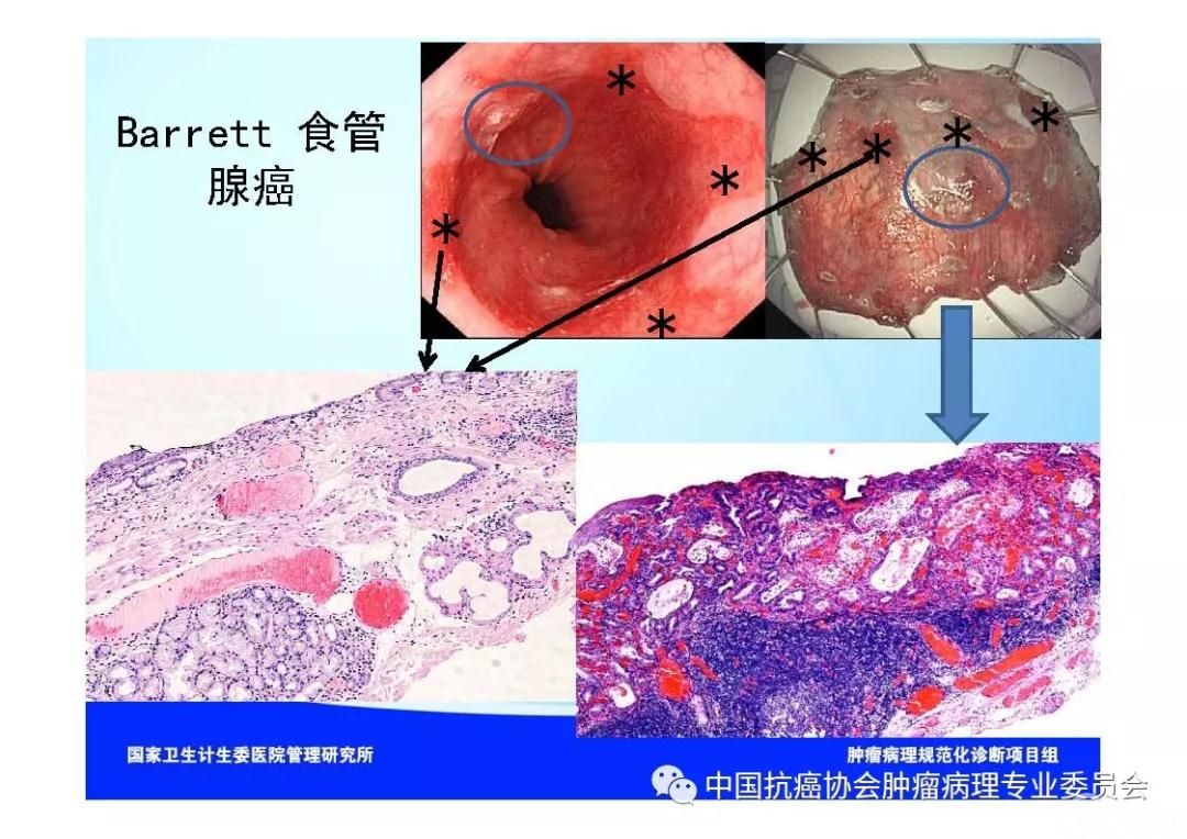 肿瘤病理规范化诊断标准 第7部分:食管癌病理诊断标准