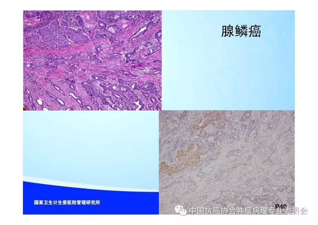 肿瘤病理规范化诊断标准 第7部分:食管癌病理诊断标准