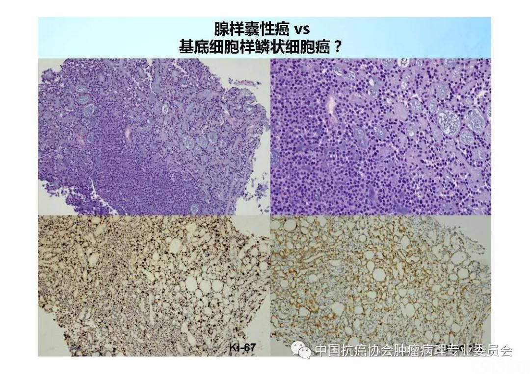 肿瘤病理规范化诊断标准 第7部分:食管癌病理诊断标准