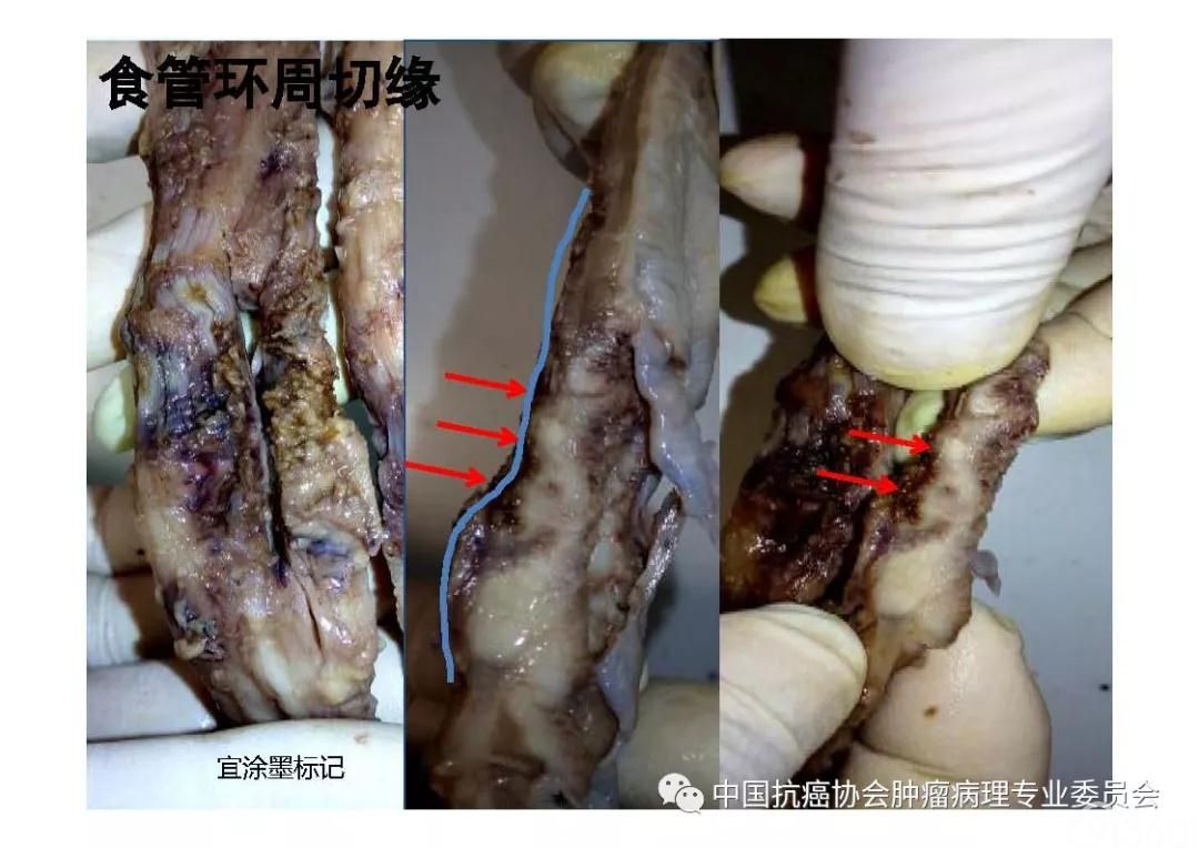 肿瘤病理规范化诊断标准 第7部分:食管癌病理诊断标准