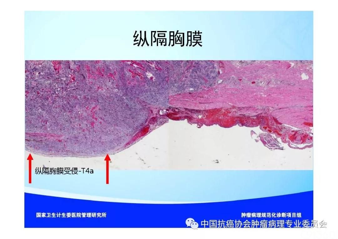 肿瘤病理规范化诊断标准 第7部分:食管癌病理诊断标准