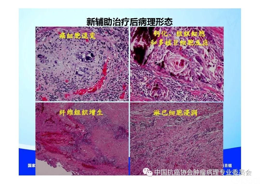 肿瘤病理规范化诊断标准 第7部分:食管癌病理诊断标准