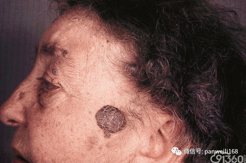 9 脂溢性角化症:老年女性的多发皮损.fig. 24.