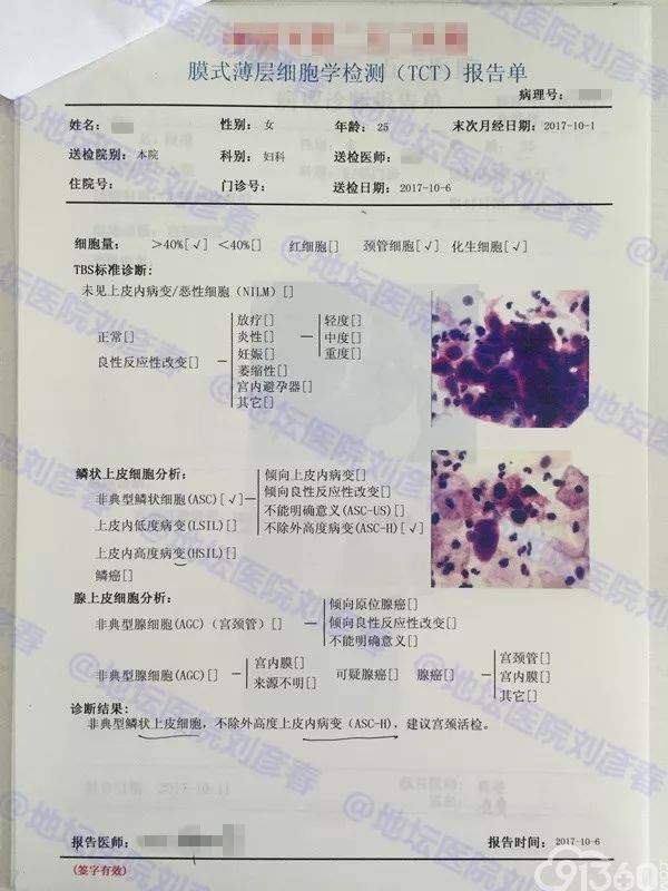 病例分享——25岁的宫颈高度病变患者