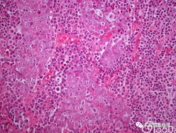 淋巴上皮癌   肿瘤细胞胞核空泡状,淋巴组织丰富