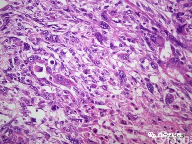 病理杂谈唾液腺恶性肿瘤【本站为非盈利学术交流平台,部分资料