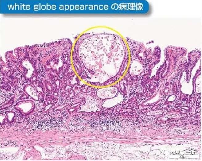 he染色显示扩张的异型腺管内存在变性坏死的脱落肿瘤细胞含嗜酸性物质