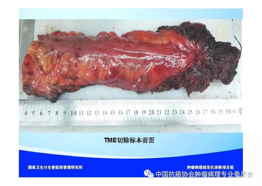 肿瘤病理诊断规范 第9部分:结直肠癌病理诊断规范