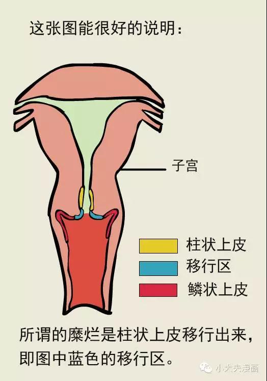 宫颈糜烂不是病?