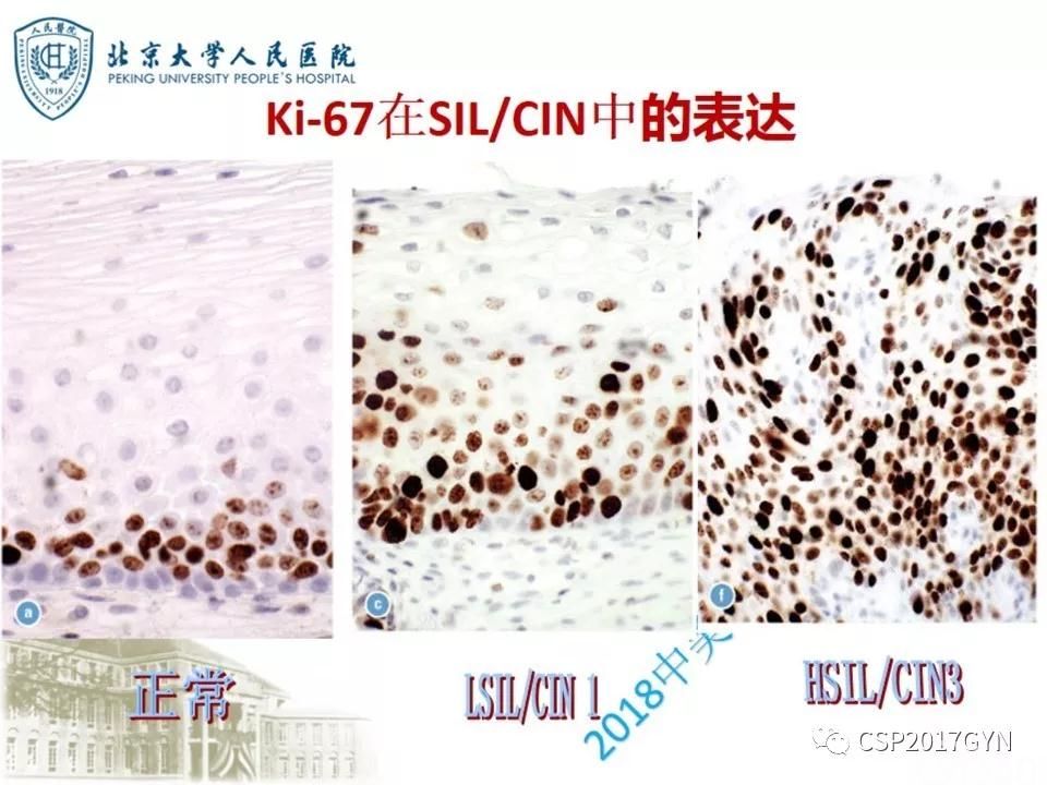 宫颈鳞状上皮内病变病理诊断中问题