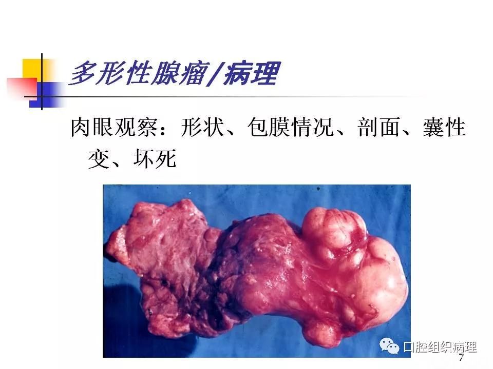 多形性腺瘤为主