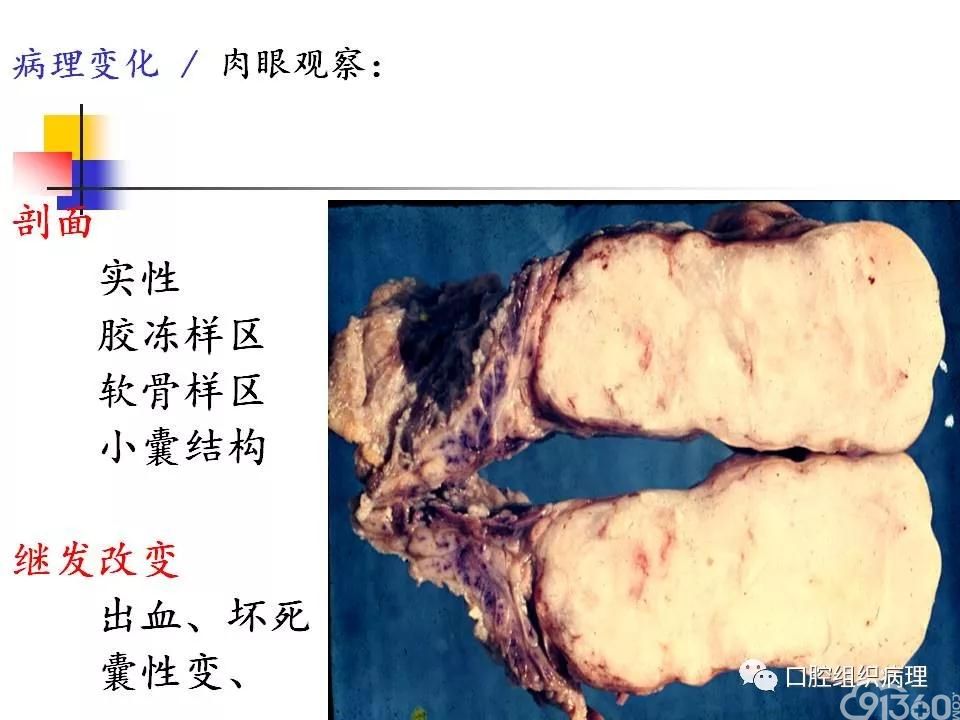 多形性腺瘤为主