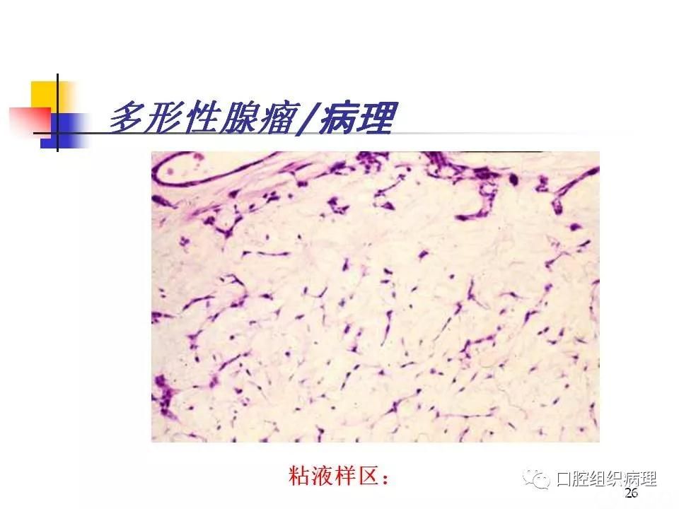 多形性腺瘤为主 - 91360智慧病理网