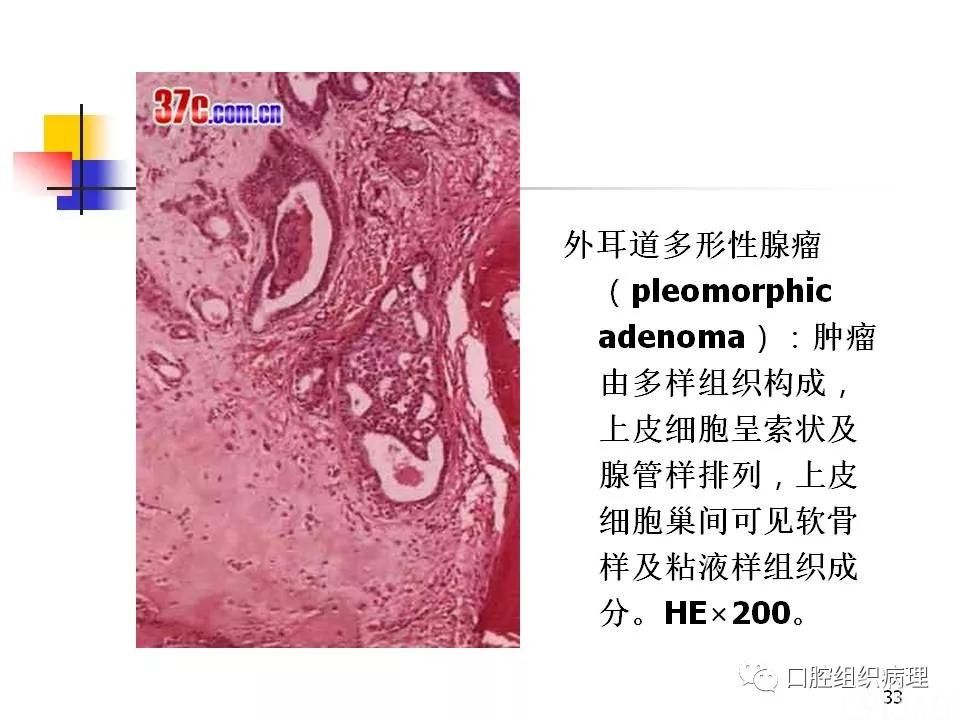 多形性腺瘤为主 - 91360智慧病理网