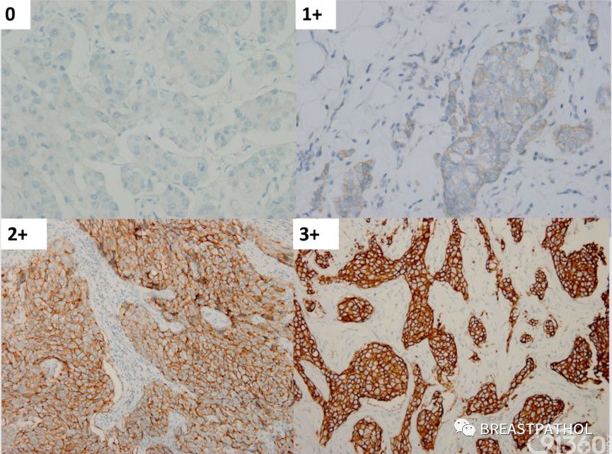 免疫组化在乳腺病理诊断中的应用