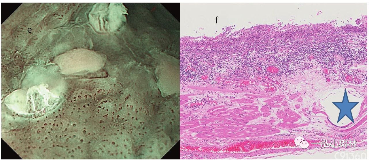 早期食管癌浸润深度诊断91360智慧病理网(手机版)